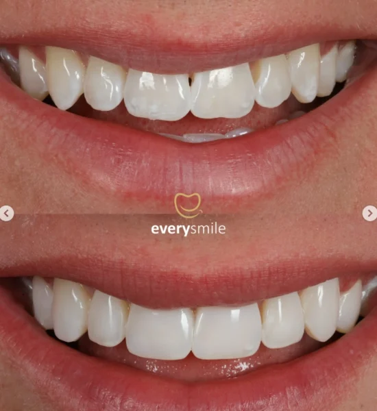 Smile Makeover | Everysmile Dental Leicester - 11