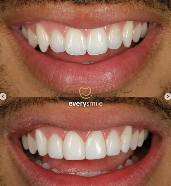 Smile Makeover | Everysmile Dental Leicester - 12