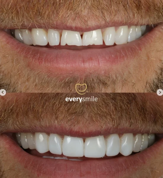 Smile Makeover | Everysmile Dental Leicester - 13