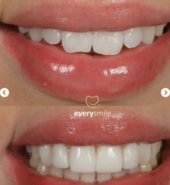Smile Makeover | Everysmile Dental Leicester - 14