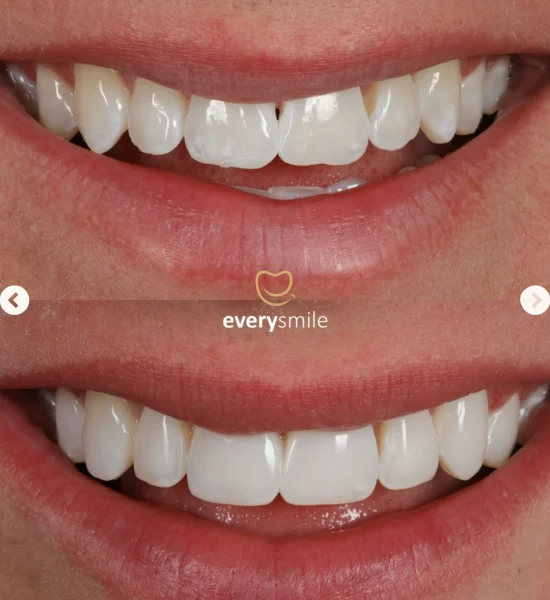 Smile Makeover | Everysmile Dental Leicester - 6