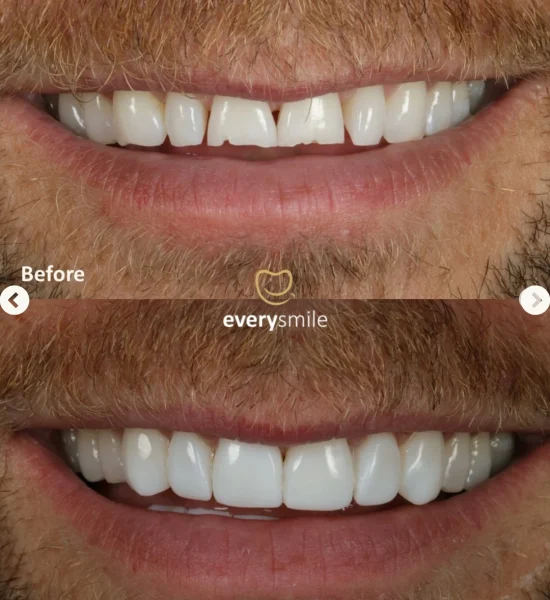 Smile Makeover | Everysmile Dental Leicester - 7