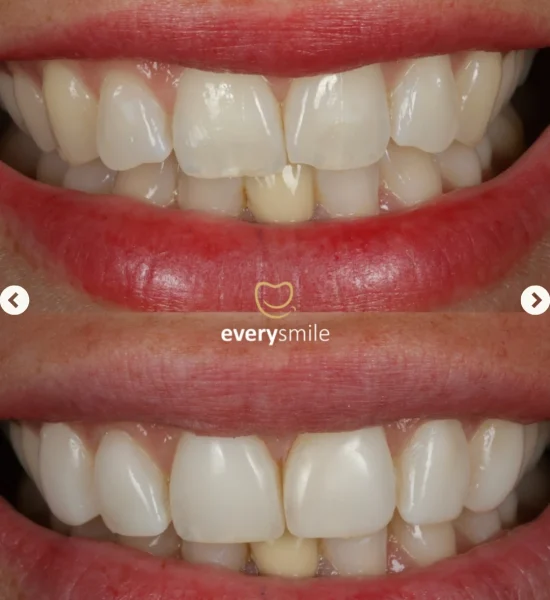 Smile Makeover | Everysmile Dental Leicester - 8