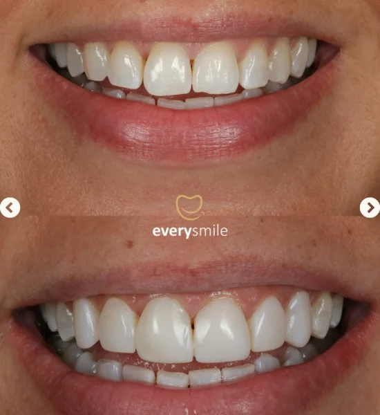 Smile Makeover | Everysmile Dental Leicester - 9